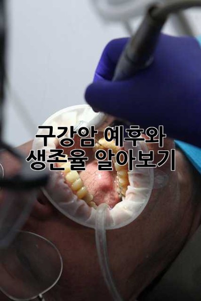 구강암 예후와 생존율 알아보기